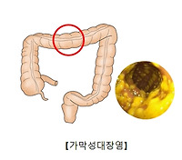 위막성 대장염