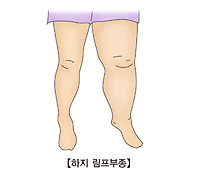 림프 부종