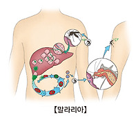 말라리아