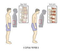 강직성 척추염