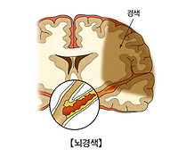 뇌경색