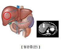 간 혈관종