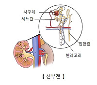 신부전