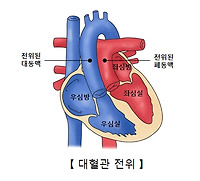 대혈관 전위