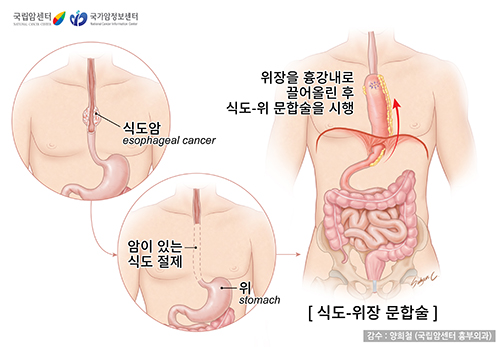 위장을 흉강 내로 끌어 올린 후 식도를 절제하고 식도-위 문합술을 시행하는 모습