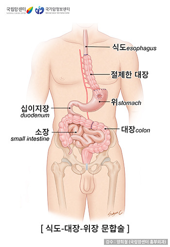 대장을 이용하여 식도-대장-위장 문합술을 시행한 모습 