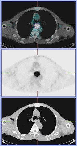 식도암에서 PET 스캔 (PET/CT)