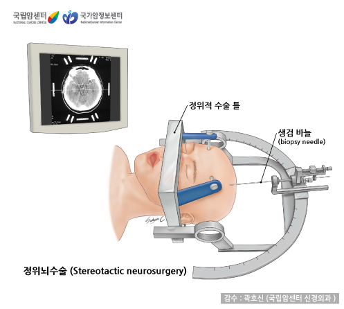 정위뇌수술