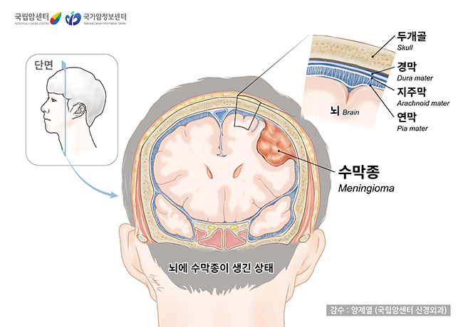 수막의 구조와 수막종이 생긴 상태