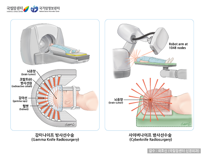 감마나이프와 사이버나이프 방사선 치료