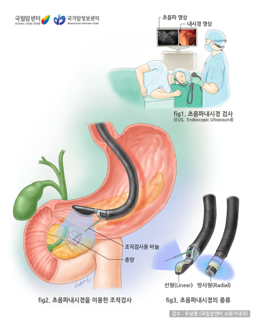 내시경 초음파검사(EUS)