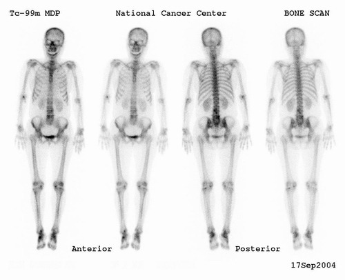 식도암에서 전신 뼈 스캔
