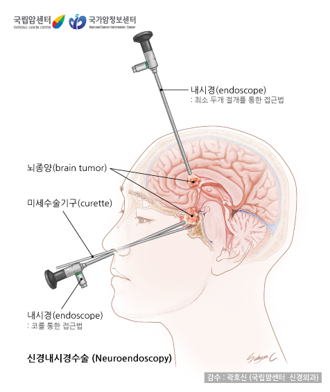 신경내시경수술