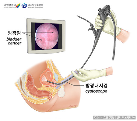 방광내시경 검사