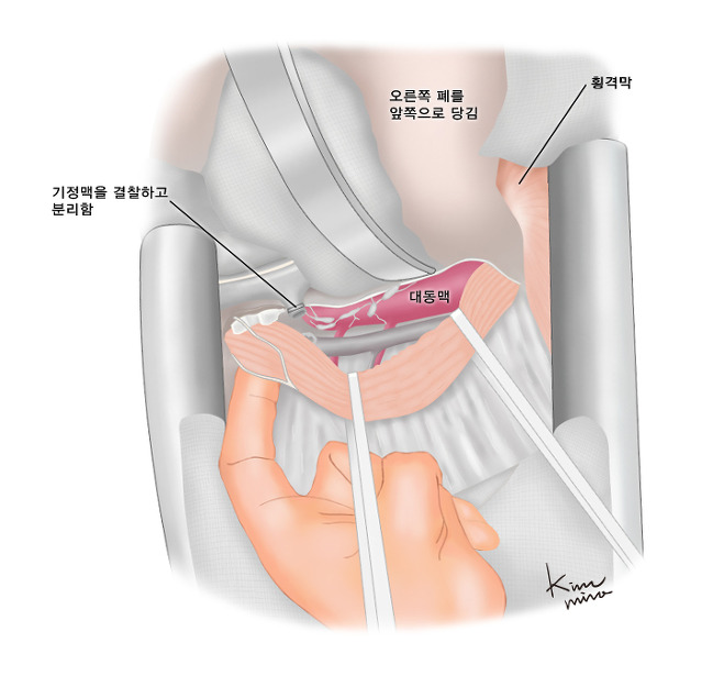 개흉술하에서 식도를 주위조직과 분리하는 모습 - 기정맥을 결찰하고 분리함, 오른쪽 폐를 앞쪽으로 당김, 횡경막, 대동맥