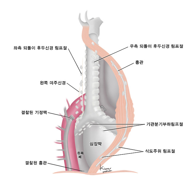 식도절제술시 같이 시행하는 림프절 제거술 - 좌측 되돌이 후두신경 림프절, 왼쪽 미주신경, 결찰된 기정맥, 결찰된 흉관, 우측 되돌이 후두신경 림프절, 흉광, 기관분기부하림프절, 식도주위 림프절, 왼쪽폐, 심장막