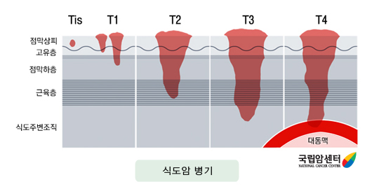 식도암 병기 - 점막상피, 고유층, 점막하층, 근육층, 식도주변조직, Tis, T1, T2, T3, T4