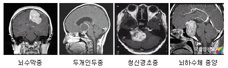 양성 뇌종양