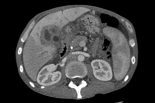 간암(liver cancer)