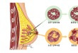 유방암의 종류 - 유관, 유관 상피내암, 침윤성 유관암, 소엽, 소엽 상피내암, 침윤성 소엽암