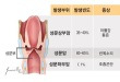 후두암의 발생부위에 따른 분류