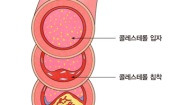 이상지질혈증