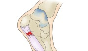 족저 근막염