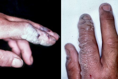 File:HF burned hands.jpg