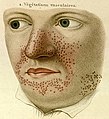 The earliest illustration of tuberous sclerosis, displayed in Rayer's 1835: "Traité des maladies de la peau".