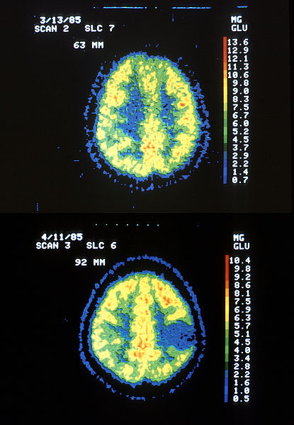 File:Astrocytoma.jpg