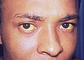 Hepatitis A induced jaundice