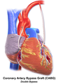 Illustration of Double bypass