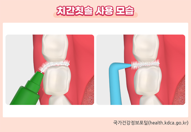 치간칫솔 사용 모습